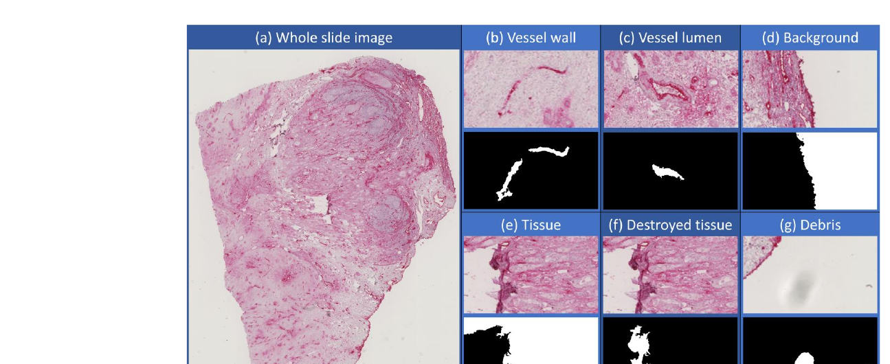 Histologischer Gewebeschnitt mit Beispielausschnitten für die sechs Segmentierungsklassen